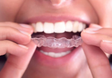 invisalign-braces-370x260